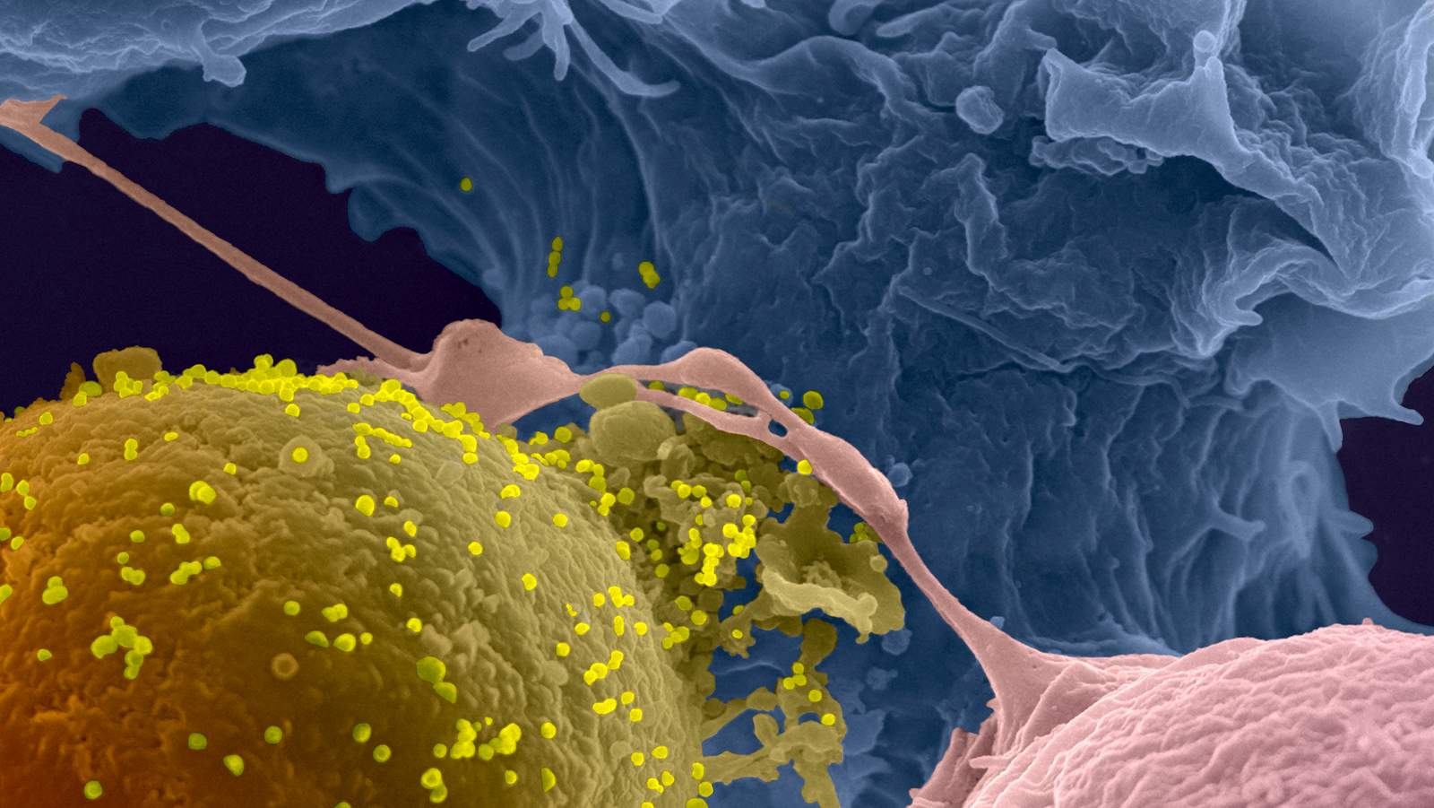 Contact entre un lymphocyte infecté par le VIH (en jaune) avec un lymphocyte non-infecté. Image acquise par microscopie électronique à balayage.