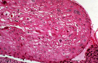 Papillomavirus dans une biopsie de col utérin