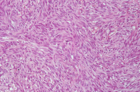 Faisceaux de cellules fusiformes dans le sarcome de Kaposi.