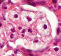 Alvéole pulmonaire de souris infectée par Klebsiella rhinoscleromatis