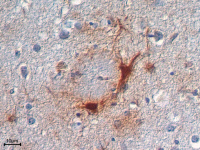 Plaque amyloïde caractéristique de la maladie d'alzheimer