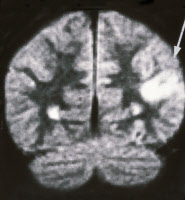 Lymphome cérébral d'un patient atteint du sida