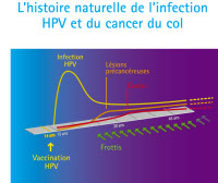 Histoire naturelle de l'infection HPV et du cancer du col