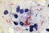 Mycobacterium tuberculosis par la coloration de Ziehl-Neelsen