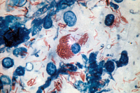 Mycobacterium tuberculosis par la coloration de Ziehl-Neelsen