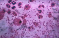 Bactéries Yersinia pestis dans un crachat de malade atteint de peste pulmonaire