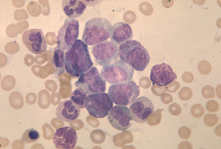 Leucémie myéloïde aigüe : monoblastes