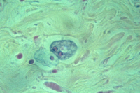 Coupe histologique d'intestin infecté par Entamoeba histolytica