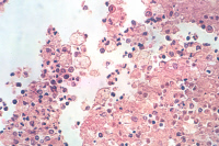 Coupe histologique de foie infecté par Entamoeba histolytica