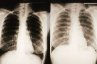 Pneumocystose pulmonaire