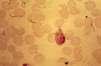 Plasmodium ovale