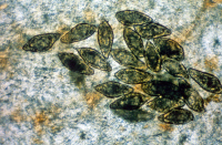 Oeufs de Schistosoma haematobium dans une biopsie rectale humaine