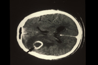 Scanner X du système nerveux central d'un patient atteint du sida