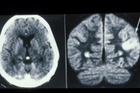 Lymphome cérébral d'un patient atteint du sida