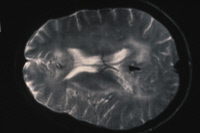 IRM du système nerveux central d'un patient séropositif VIH