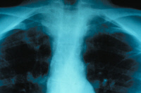 Poumons d'un malade atteint de tuberculose