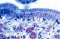 Tuberculose intestinale associée à une microsporidiose chez une personne VIH-positive