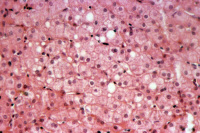Coupe histologique de foie de patient atteint d'hépatite C chronique