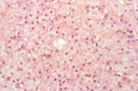 Coupe histologique de foie de patient atteint d'hépatite C chronique