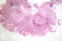 Coupe histologique d'estomac humain infecté par Helicobacter pylori