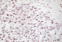 Tumeur du col de l'utérus associée à un papillomavirus