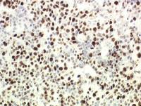 Hépatoblastome de type embryonnaire mesurée par immunomarquage de Ki67