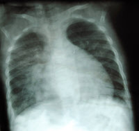 Radiographie pulmonaire - Epidémie d'entérovirus Ev71