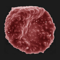 Globule rouge parasité par Plasmodium falciparum.