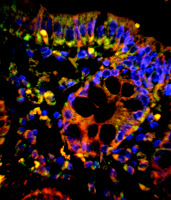 Les mitochondries dans le cancer du colon humain
