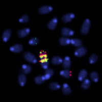 Chromosomes métaphasiques d’une cellule lymphoïde cancéreuse présentant une amplification des gènes Igh et c-myc