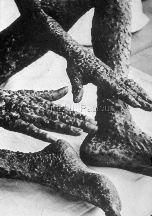 Mains et pieds d'un varioleux