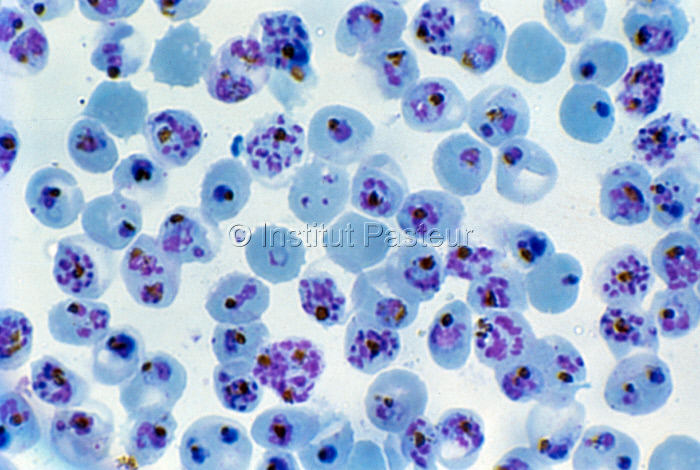 Globules rouges parasités par Plasmodium falciparum