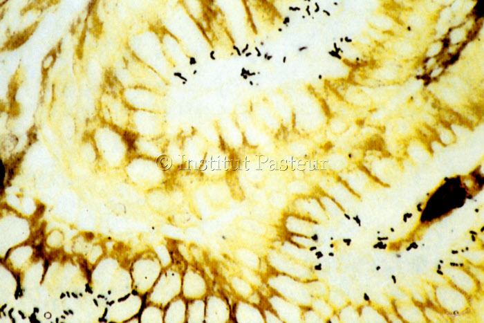 Coupe histologique d'estomac humain infecté par Helicobacter pylori