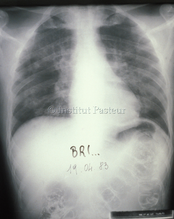 Pneumonie à Pneumocystis jirovecii chez un malade du sida en 1983
