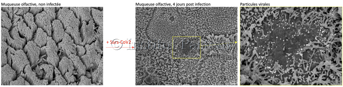 Changements de l’épithélium olfactif après infection par le SARS-CoV-2.